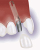 Dental implants- how can they help me?"