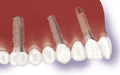 non removable teeth bridge restoration