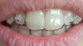 Invisible clear aligners