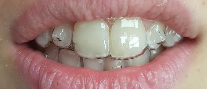 Invisible clear aligners