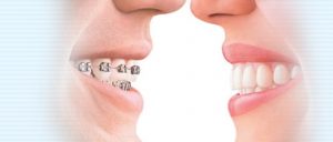 invisible clear aligners